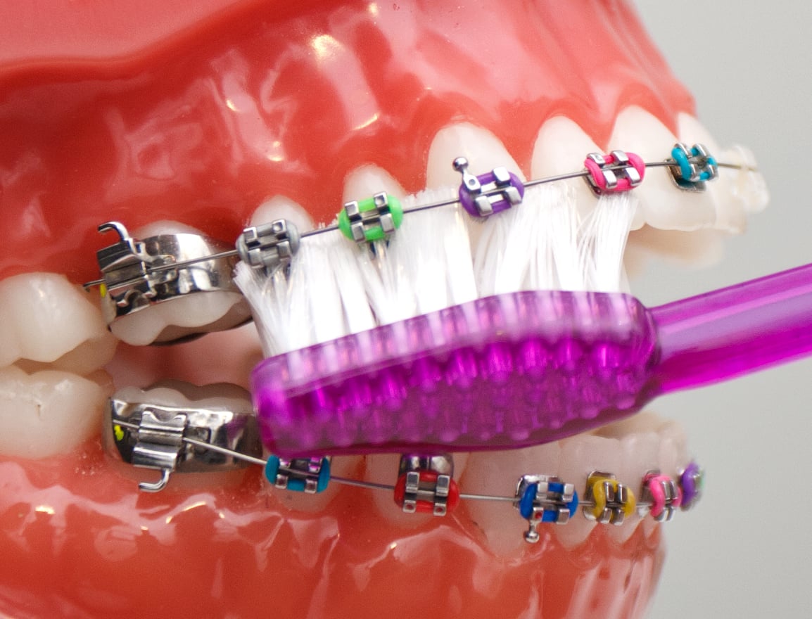 Ankara Ortodonti Fiyatları Mutludent Diş Teli Turkiye Ortodontist